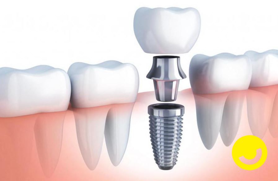 implantologia ibocca clinica dental