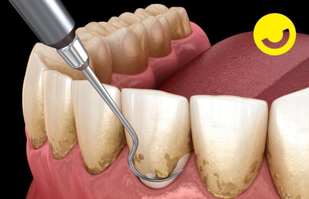 periodoncia ibocca clinica dental