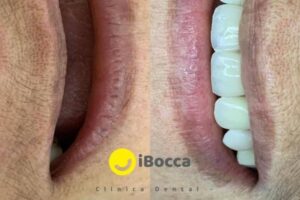 protesis dental removible clinica dental pereira ibocca