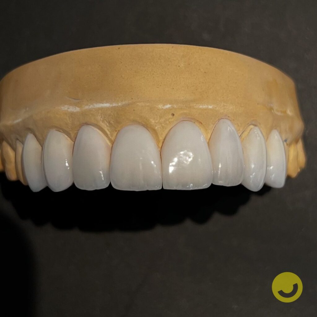 Porcelain veneers