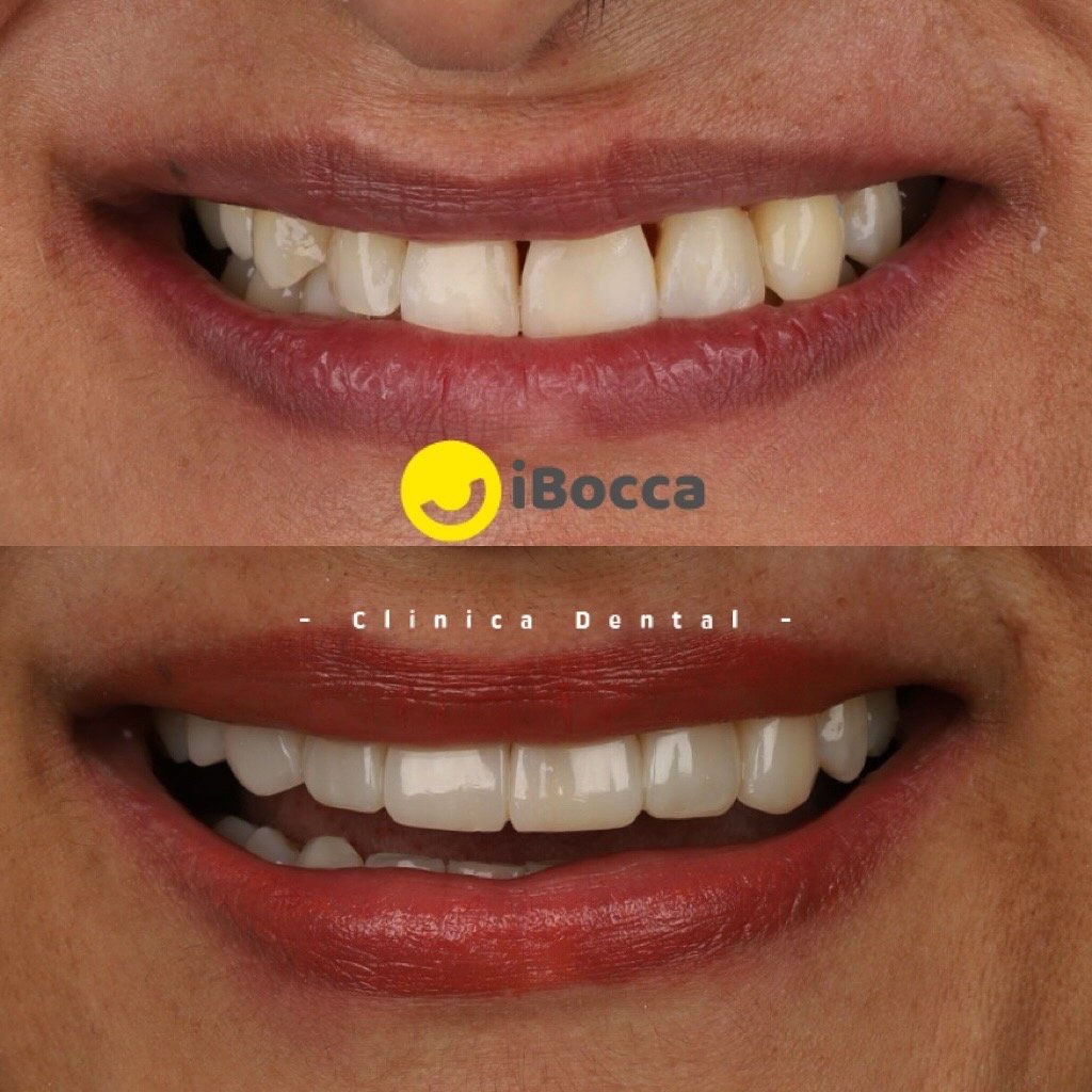smile_design_ibocca