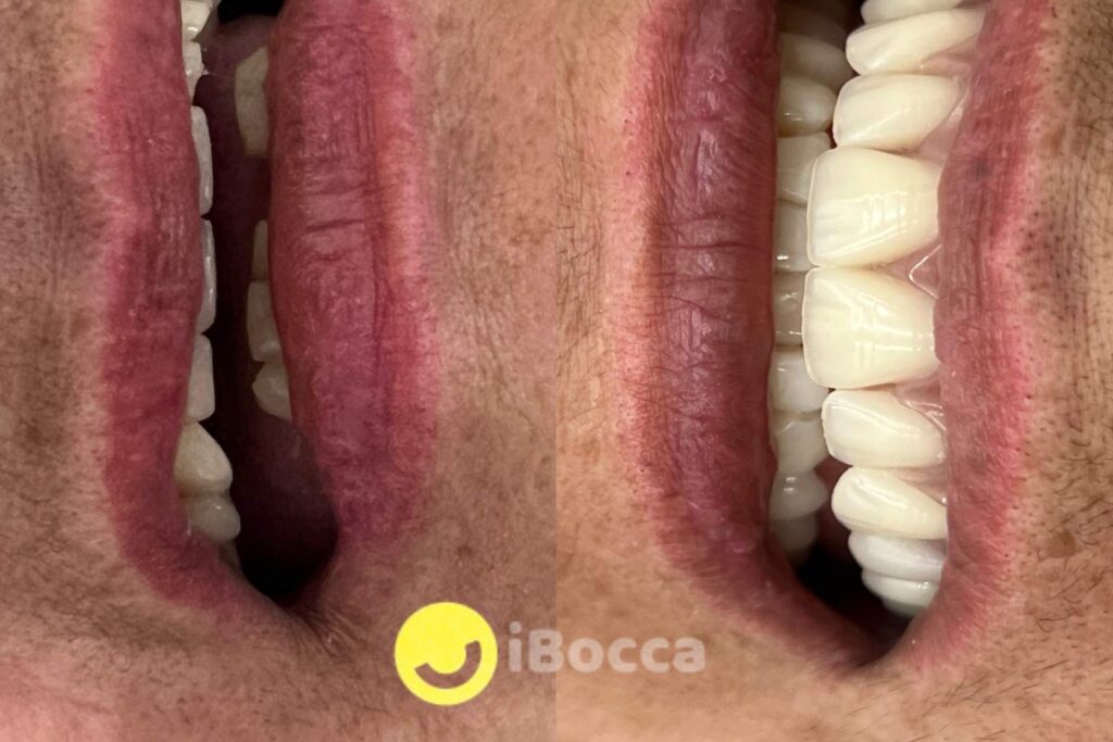Dental implant in Pereira Colombia.