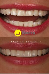 Diseño de Sonrisa en Cerámica