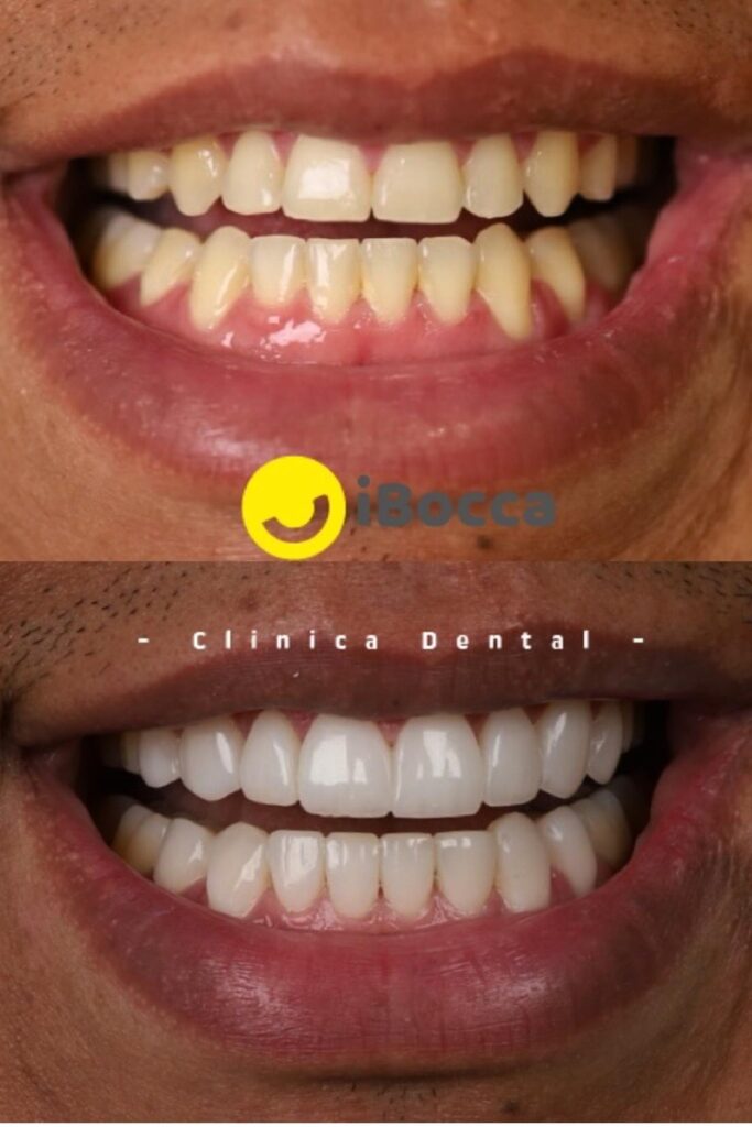 Diseño de Sonrisa en Cerámica